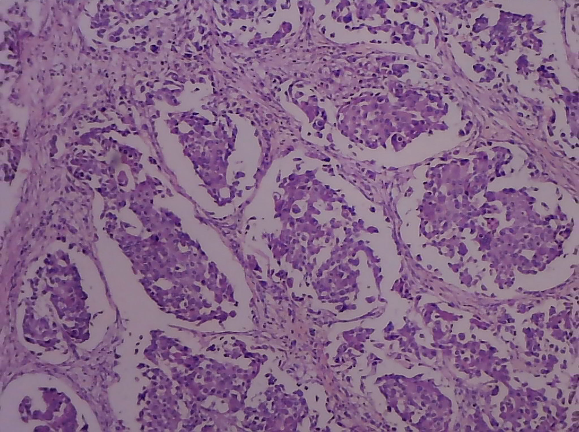 Slide, Adenocarcinoma of the Breast