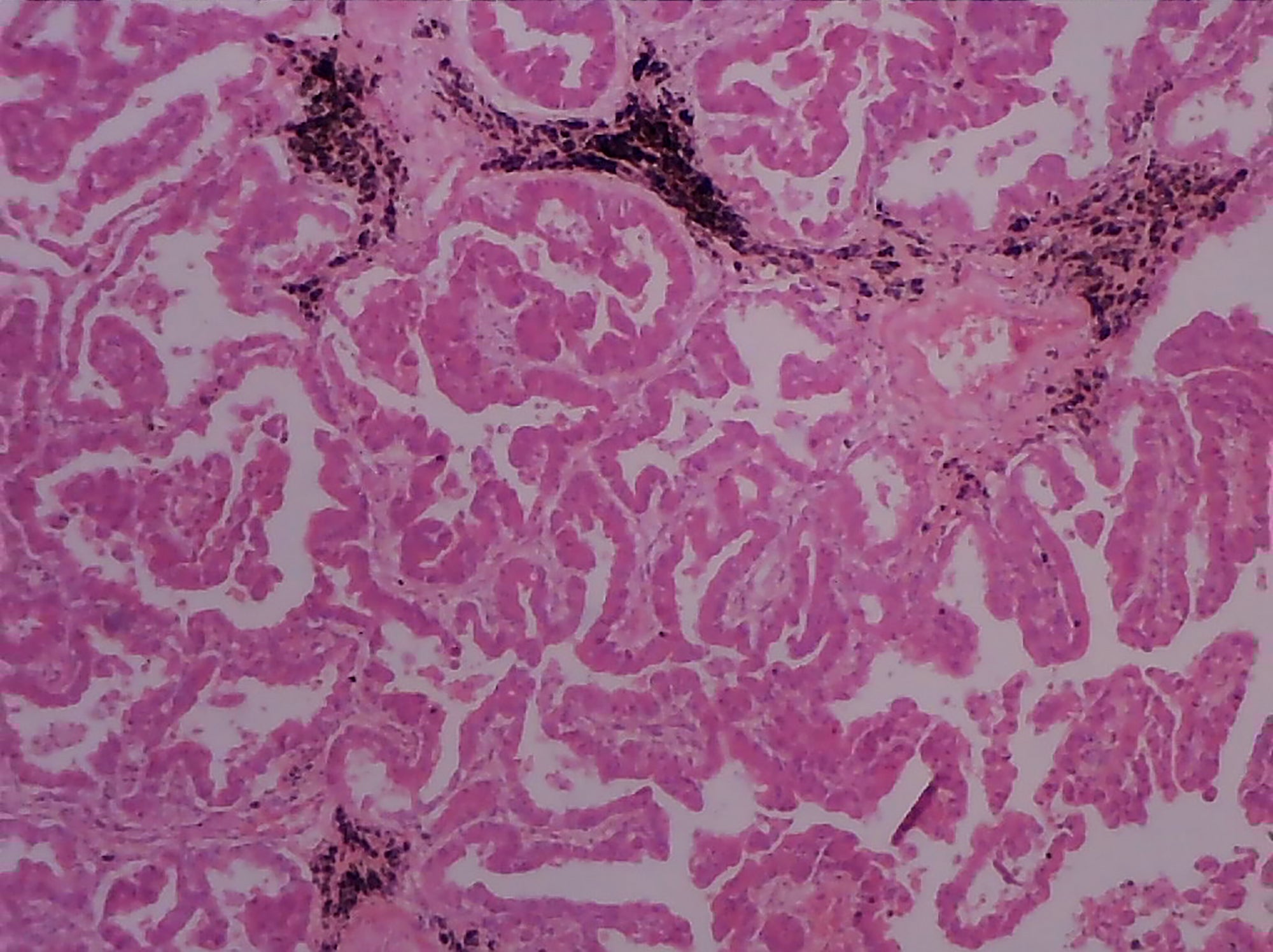 Slide, Adenocarcinoma of the Lung
