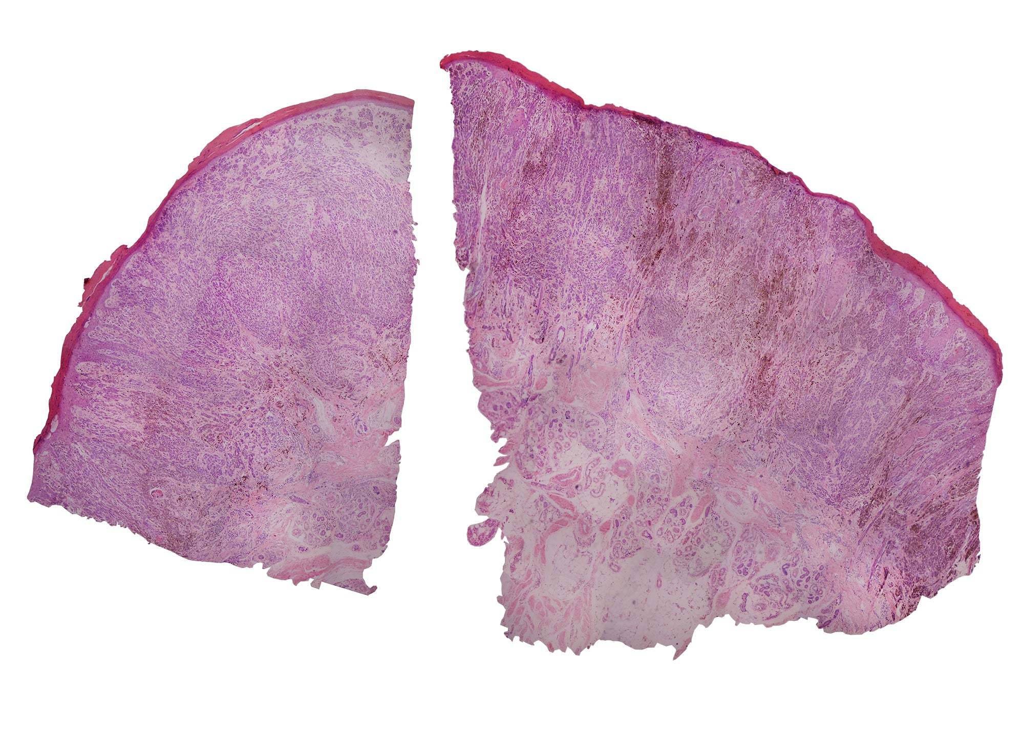 Melanoma (Human); Cross Section; H&E Stain by Go Science Crazy