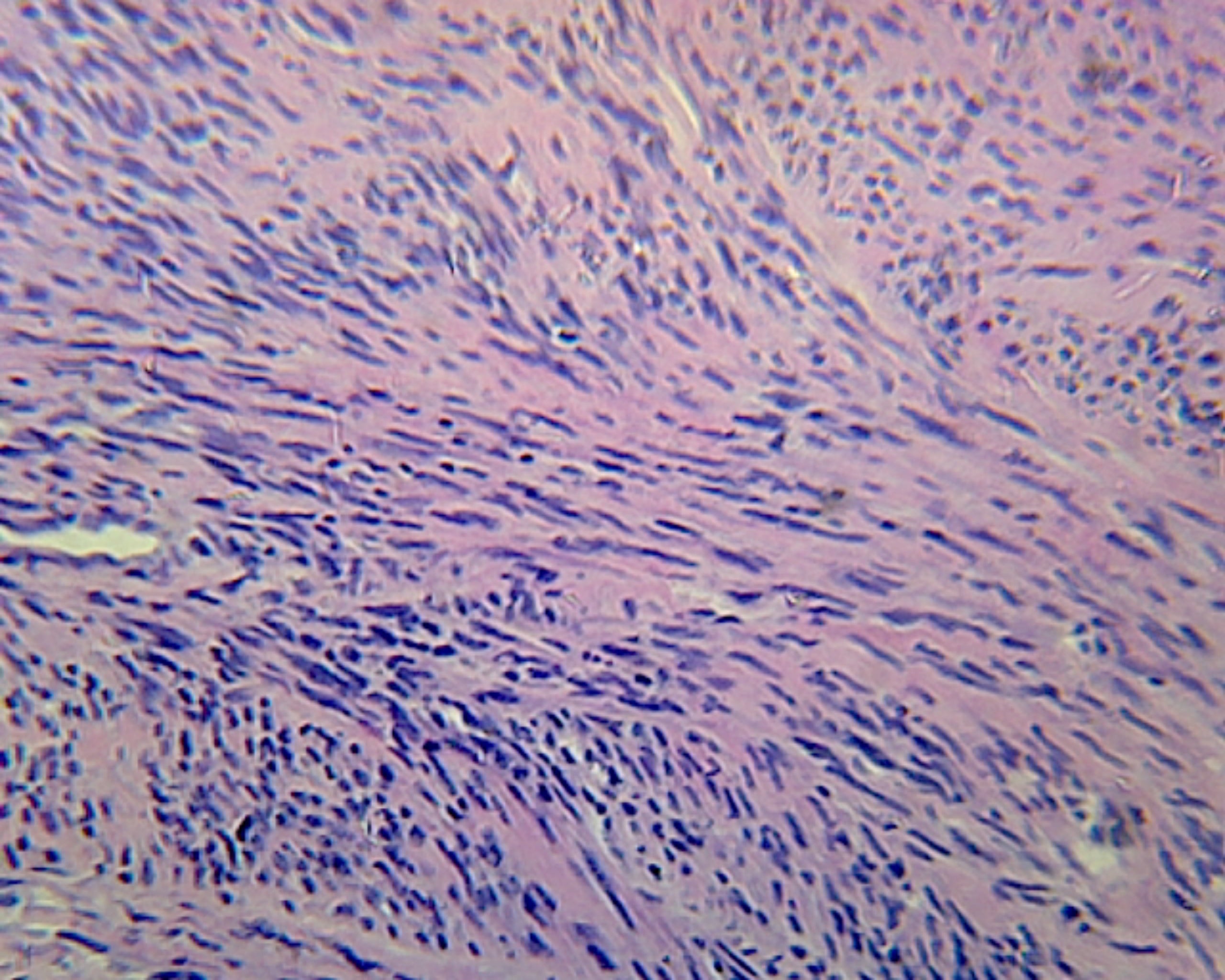 Uterus, Human; Showing Fibroid Tumor; Section; H&E Stain