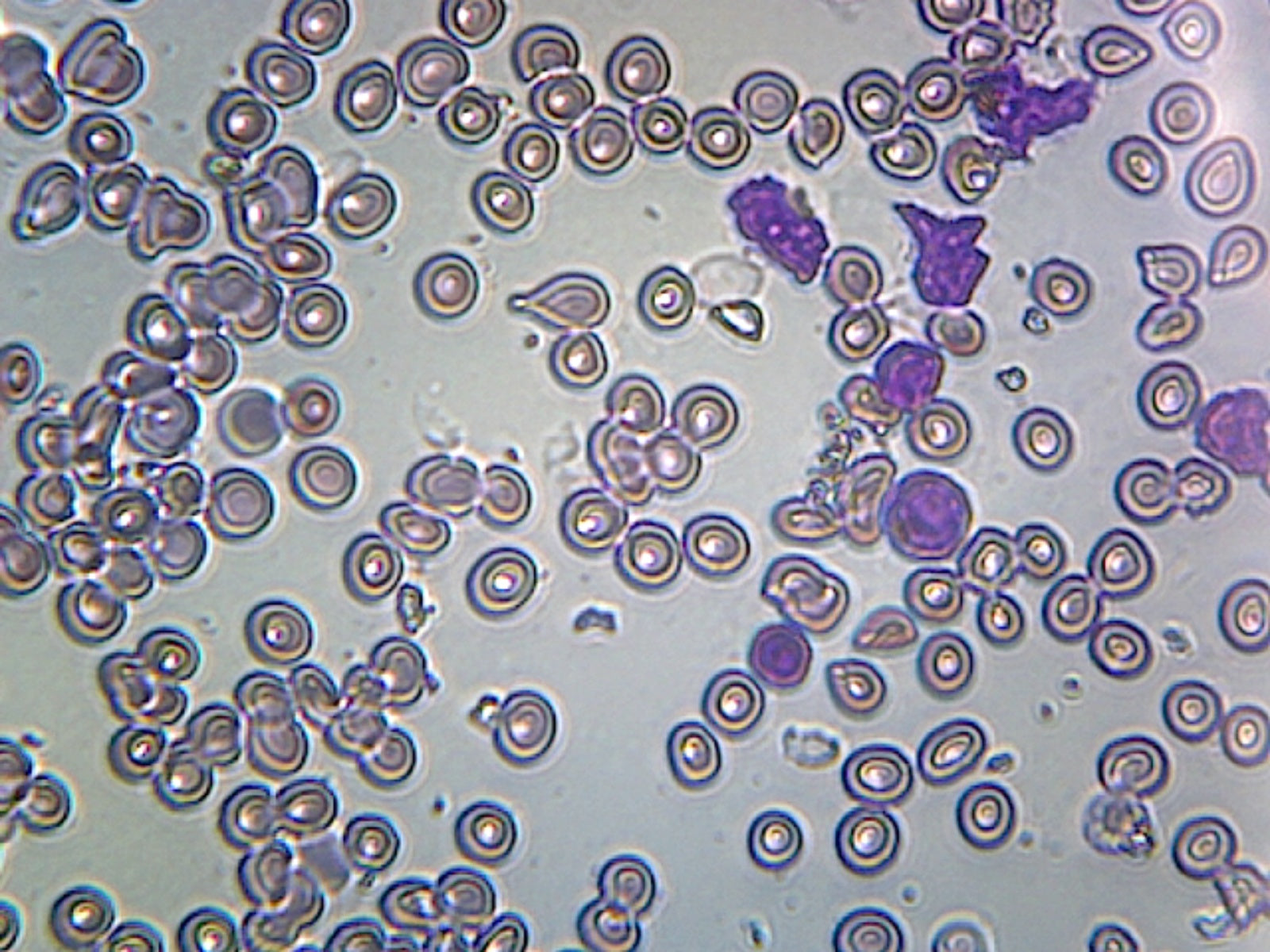 Slide , Acute Lymphatic Leukemia; Smear (From Blood); GS Stain; Showing Abnormal Lymphocytes by Go Science Crazy