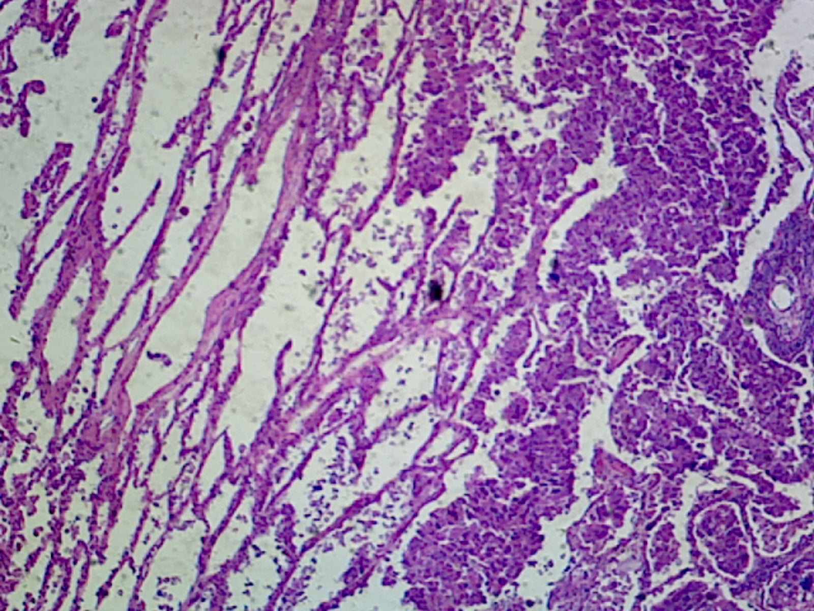 Lung Carcinoma (Human); Section; H&E Stain