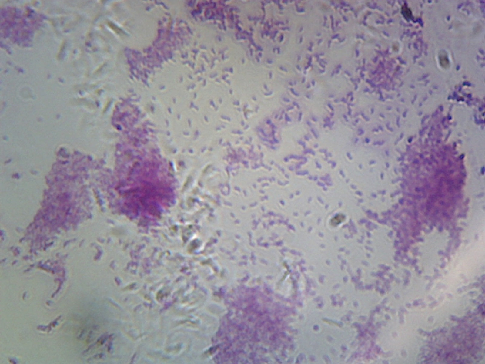 Vibrio Cholerae; Smear