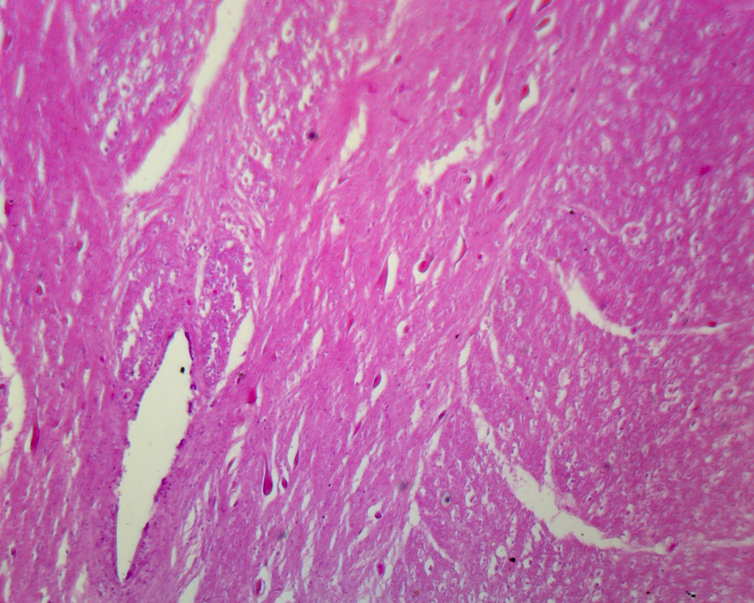 Spinal Ganglion and Nerve