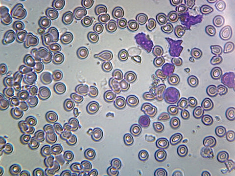 Acute Lymphatic Leukemia; Smear (From Blood); GS Stain; Showing Abnormal Lymphocytes by Go Science Crazy