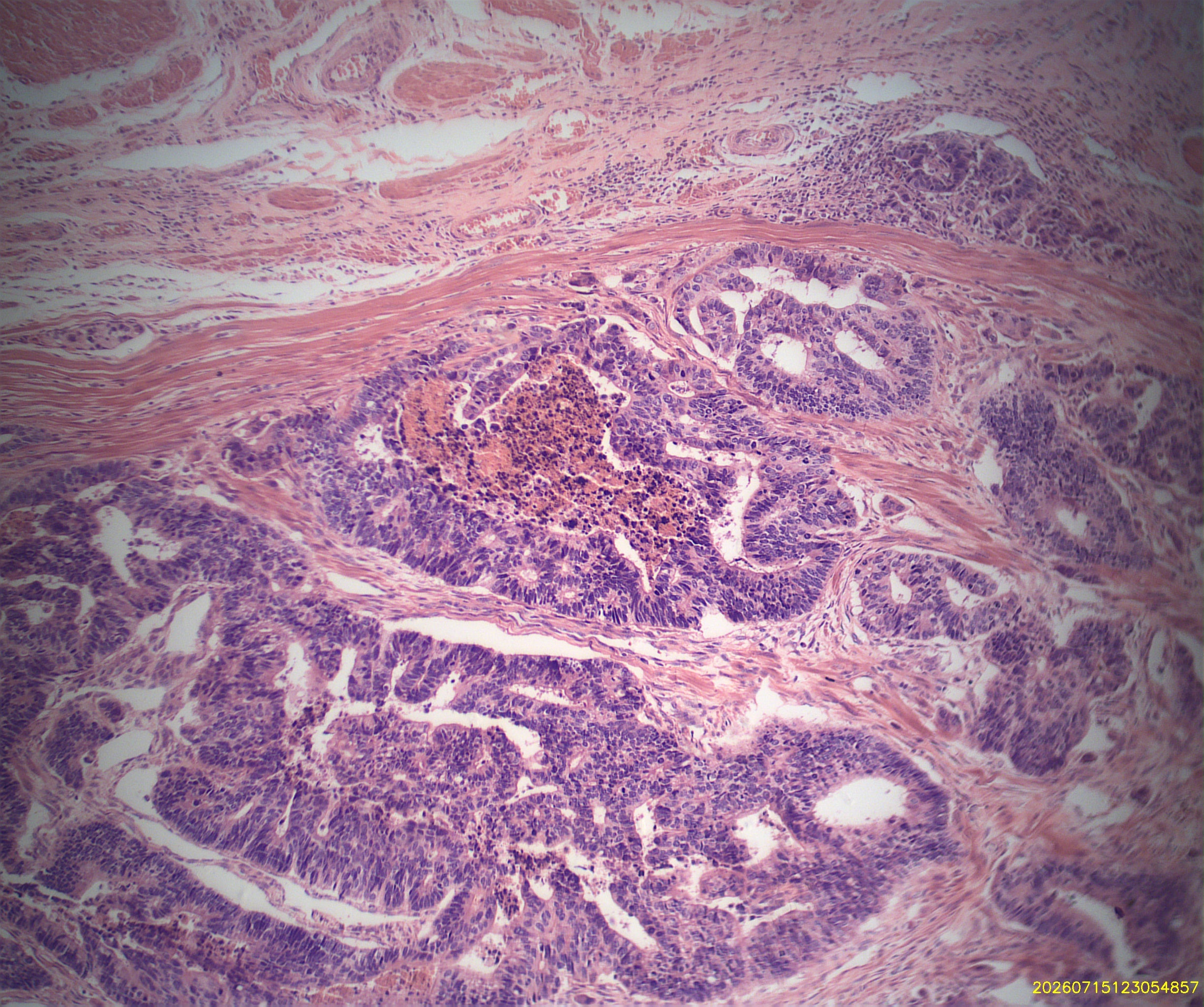 Adenocarcinoma of the Colon (Human), Prepared Microscope Slide