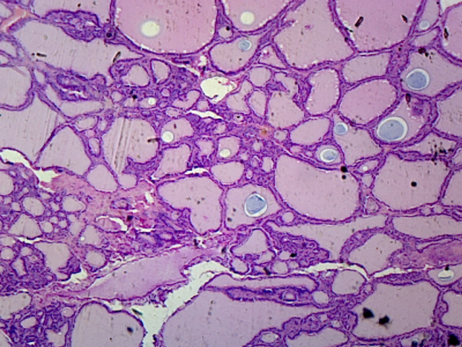 Goiter (Human Endocrine System); Section; H&E Stain by Go Science Crazy