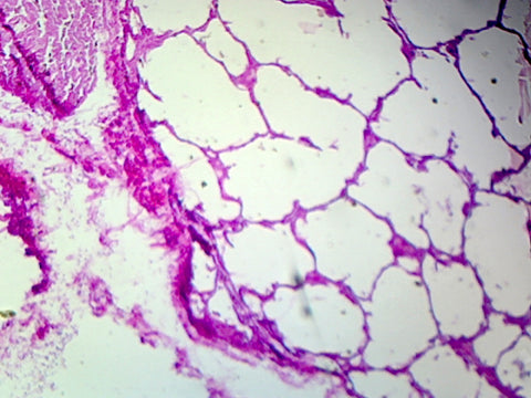 Lung of a Smoker, Human; Showing Alveoli; Section by Go Science Crazy