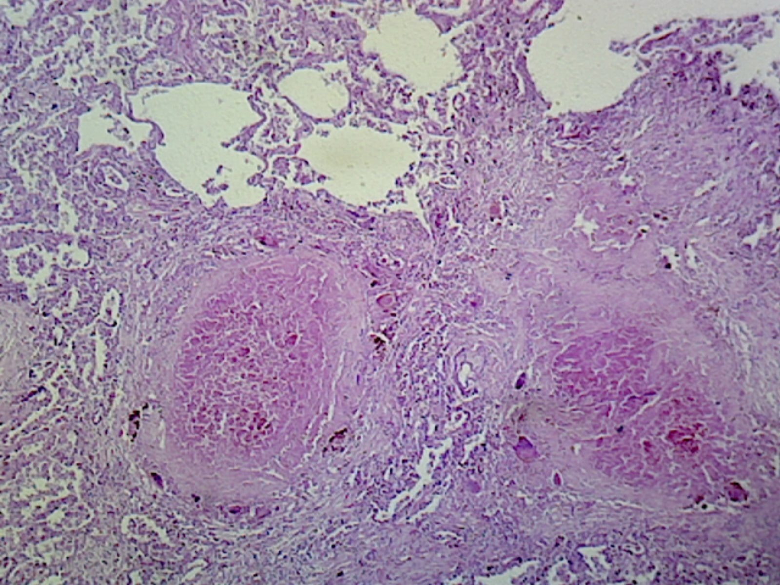 Lung Tuberculosis (Human Respiratory System); Section; H&E Stain by Go Science Crazy
