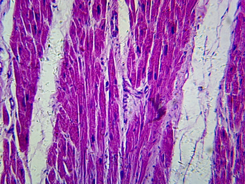 Myocardial Infarction; Section; H&E Stain; Showing Damaged Muscle by Go Science Crazy