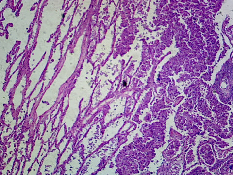 Lung Carcinoma (Human); Section; H&E Stain by Go Science Crazy