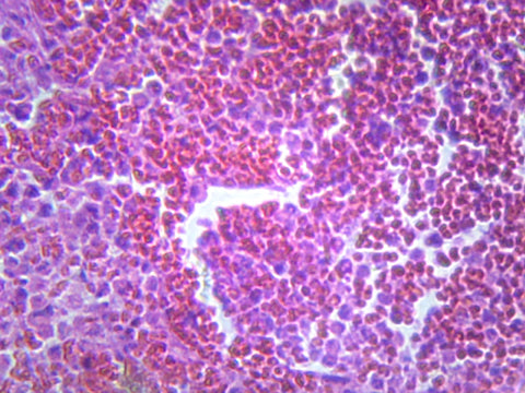 GSC International PS0322 Pneumonia (Human Respiratory System); Section; H&E Stain