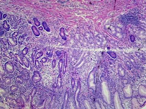 Gastric Ulcer (Human); Section; H&E Stain by Go Science Crazy